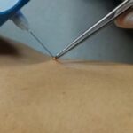 How to Remove Skin Tags Safely in Bradford